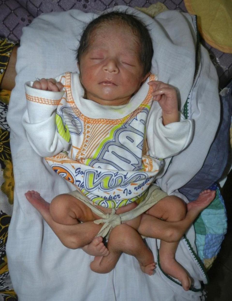 PAKISTAN: NEONATO CON 6 GAMBE, MEDICI TENTANO SALVATAGGIO