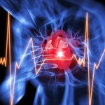 infarto