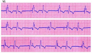 elettrocardiogramma-infarto_133076