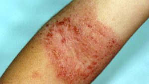 dermatite atopica