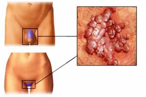 papilloma virus
