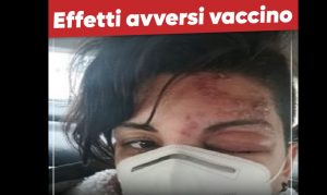 effetti avversi vaccino covid catanzaro