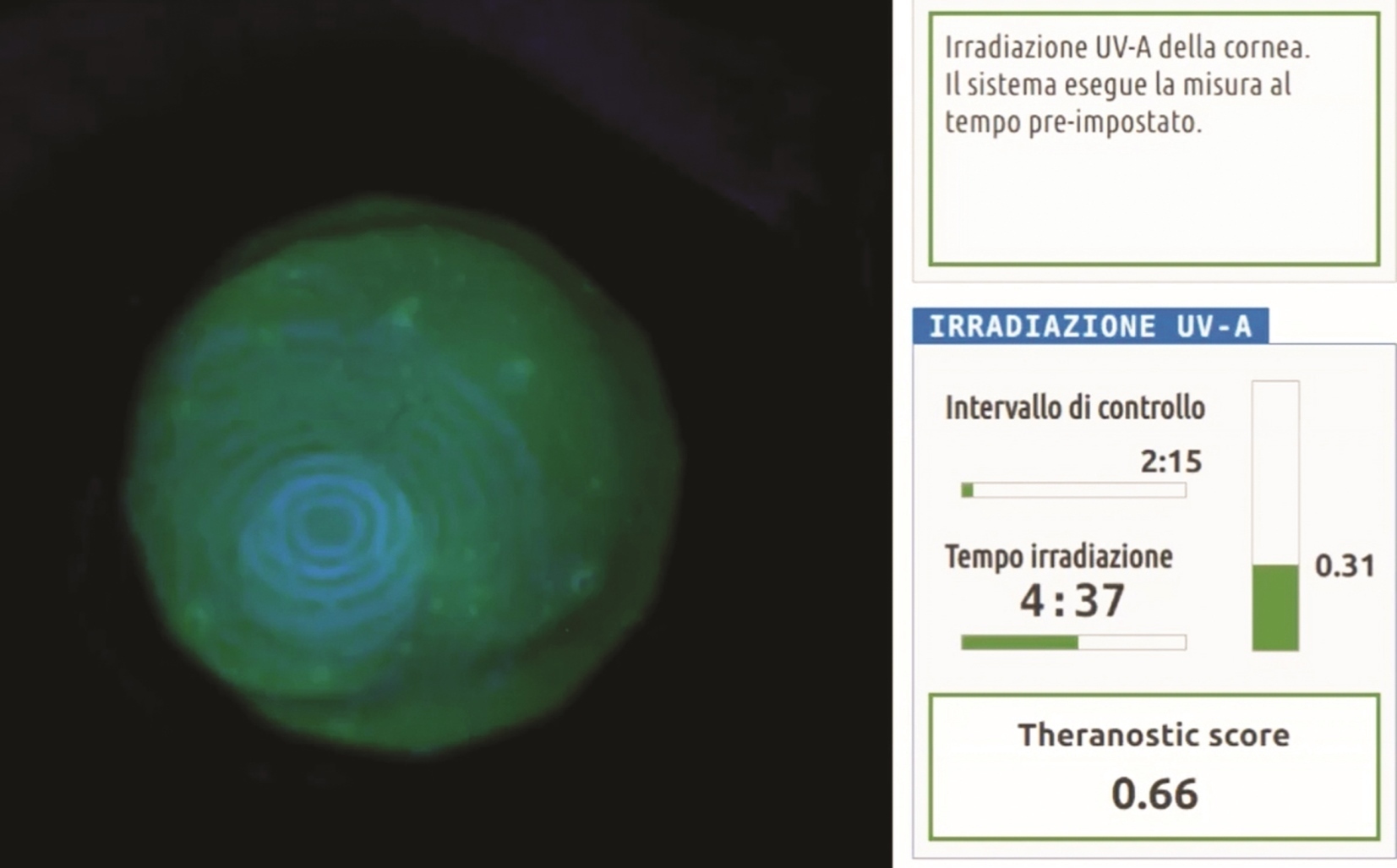 cheratocono