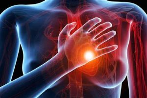 Infarto