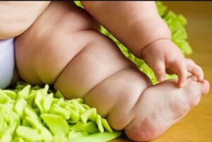 obesità infantile