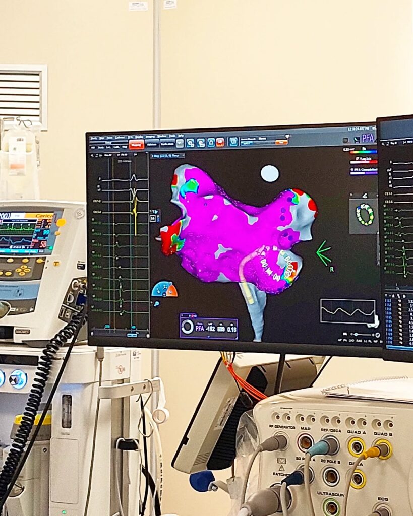 ABLAZIONE CARDIACA