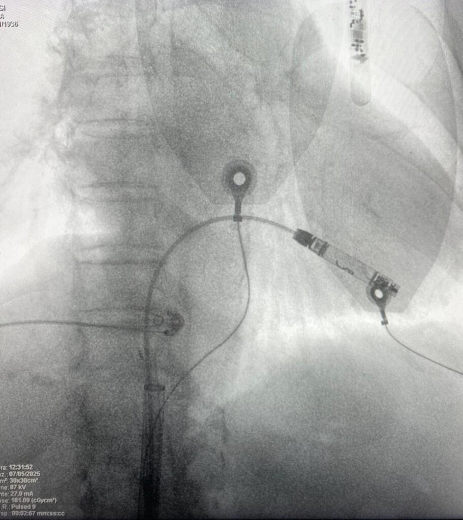 polistena intervento pacemaker
