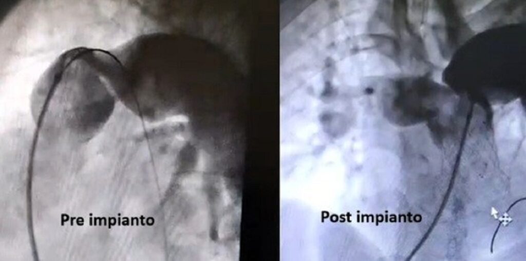 cardiopatia
