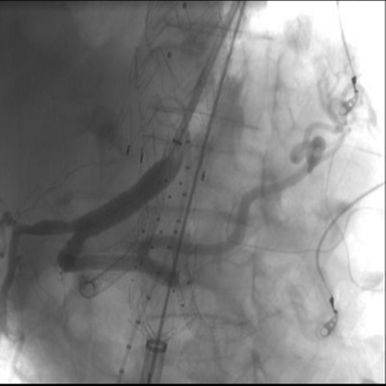 Aneurisma dell’aorta toraco-addominale