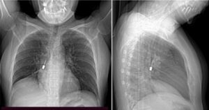 Rimosso cacciavite odontoiatrico incastrato in un bronco